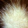 Alopecia Areata (8)