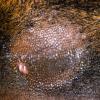Alopecia Mucinosa (10)