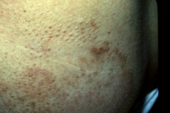 Alopecia Mucinosa (11)