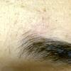 Alopecia Mucinosa (14)