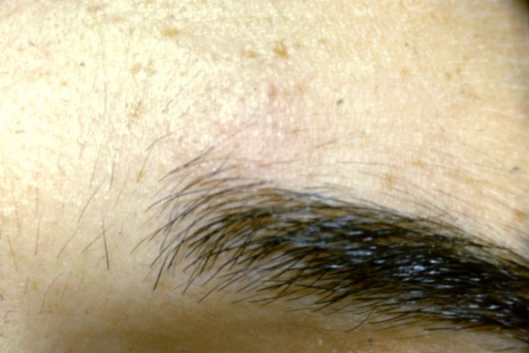Alopecia Mucinosa (14)