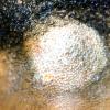 Alopecia Mucinosa (17)