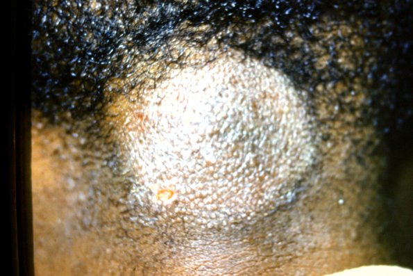 Alopecia Mucinosa (17)