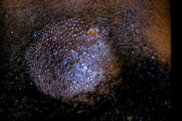 Alopecia Mucinosa (2)