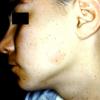 Alopecia Mucinosa (21)