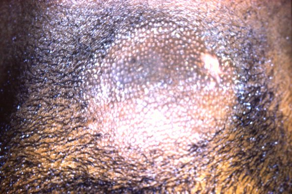 Alopecia Mucinosa (3)