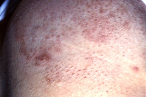 Alopecia Mucinosa (5)