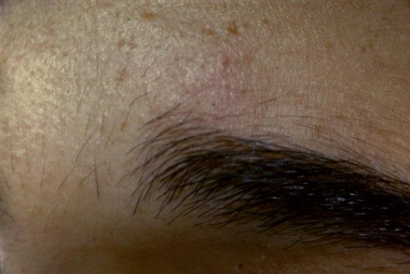 Alopecia Mucinosa (6)