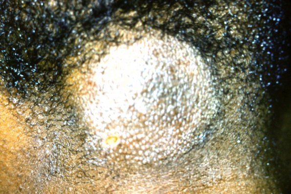 Alopecia Mucinosa (9)
