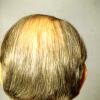 Female pattern common baldness