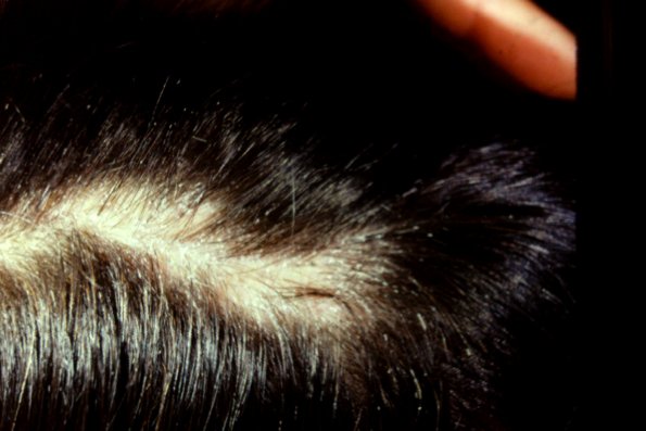 Scaring Alopecia (3)