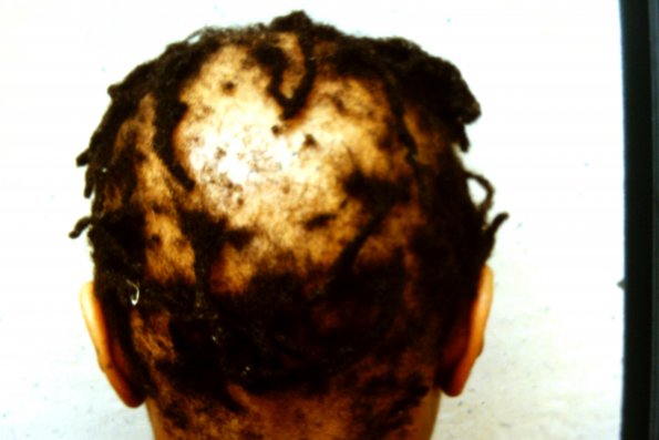 Scarring Alopecia (2)