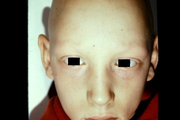 Alopecia Totalis Universalis