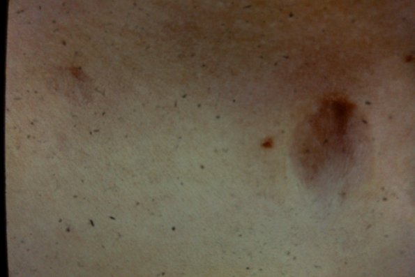 Anetoderma (16)