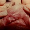 Apthaus Ulcer