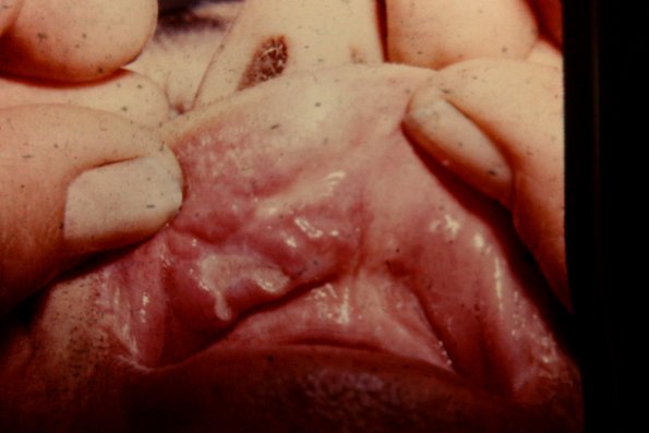 Apthaus Ulcer