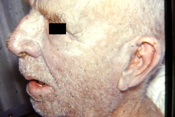 Argyria (2)