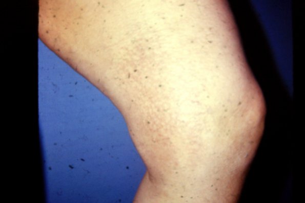 Asteatosis (5)