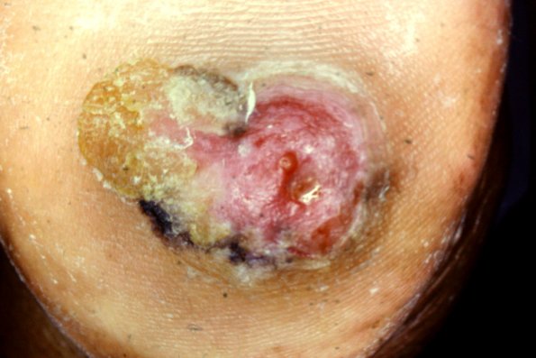 Bowen's Disease (10)