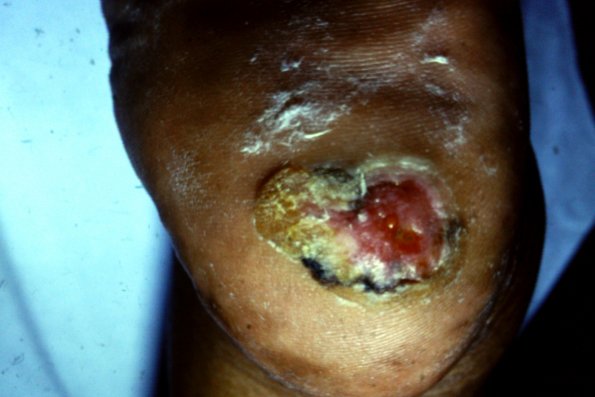 Bowen's Disease (4)