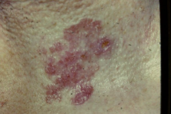 Bowen's Disease (5)