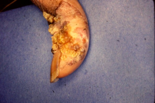 Bowen's Disease