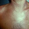 Photosensitivity Salicylanilides (4)