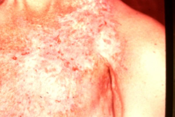 Radiodermatitis (2)