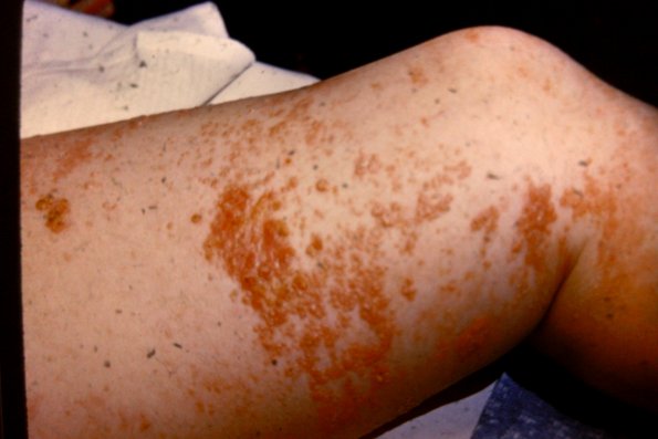 Epidermatrophic Eccrine Carcinoma (8)