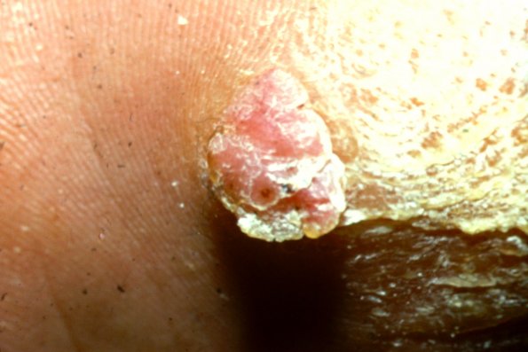 Eccrine Poroma (2)