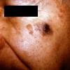 Duberneuilh's + Melanoma