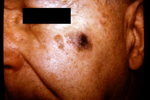 Duberneuilh's + Melanoma