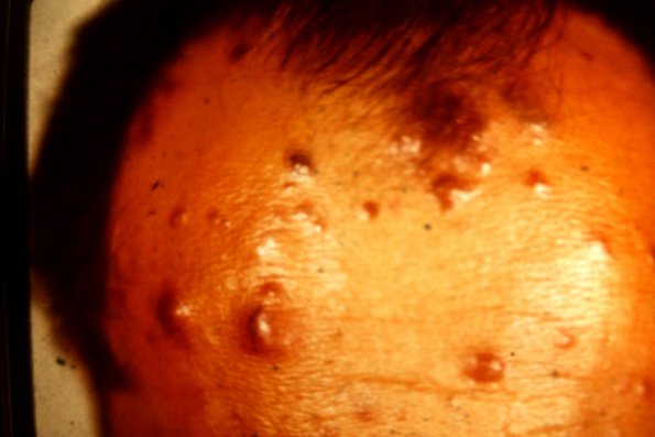 Malignant Melanoma (4)