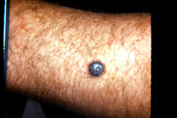 Malignant Melanoma