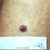 Melanoma (10)