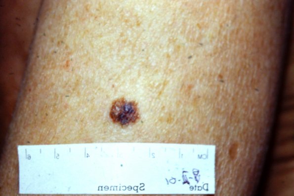 Melanoma (10)