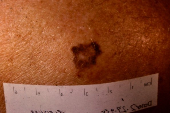 Melanoma (12)