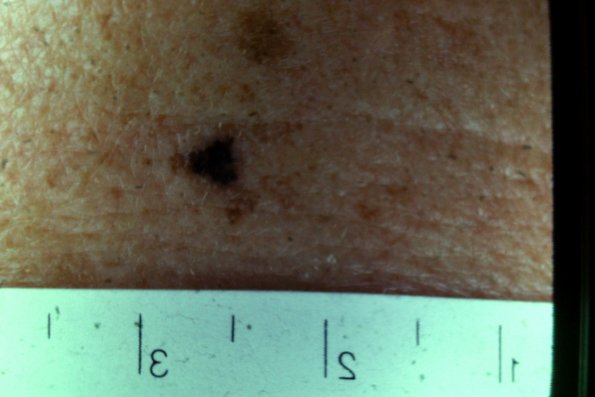 Melanoma (13)