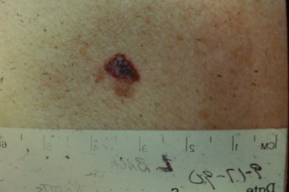 Melanoma (23)