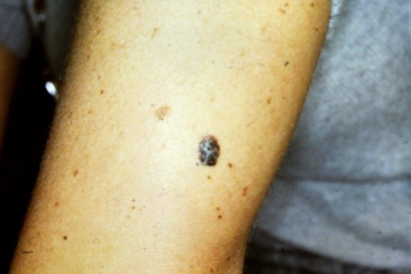 Melanoma (3)