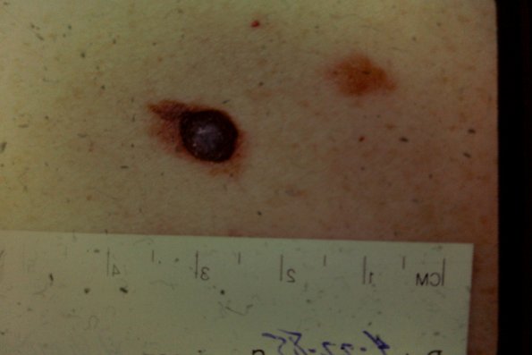 Melanoma (30)