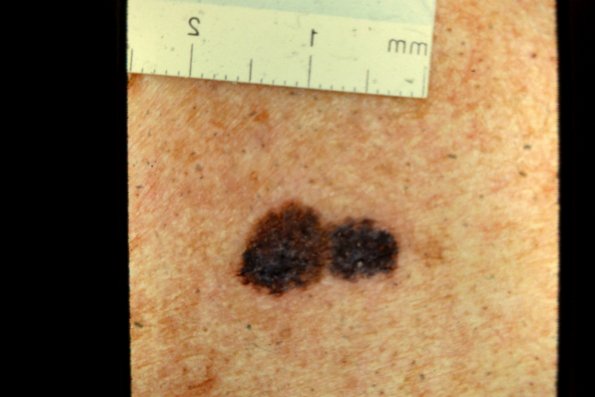 Melanoma (31)