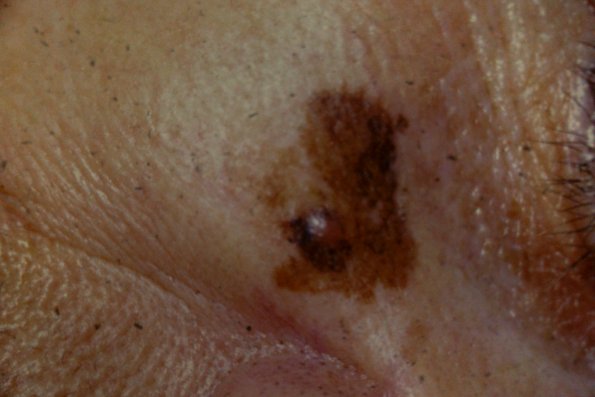 Melanoma (33)