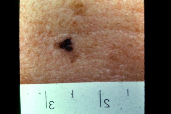 Melanoma (34)