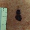 Melanoma (35)