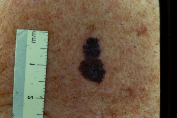 Melanoma (35)