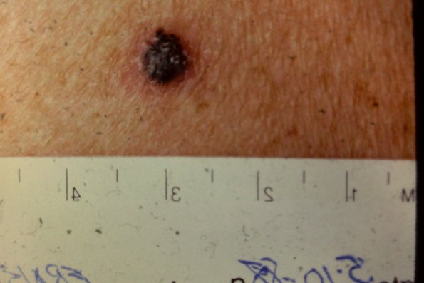 Melanoma (38)