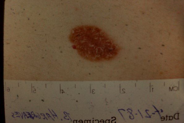 Melanoma (39)