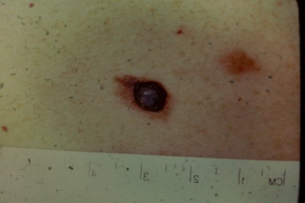 Melanoma (41)