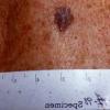 Melanoma (46)